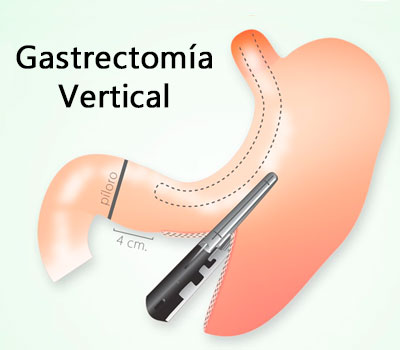 Imagen de gastrectomia vertical por laparoscopia